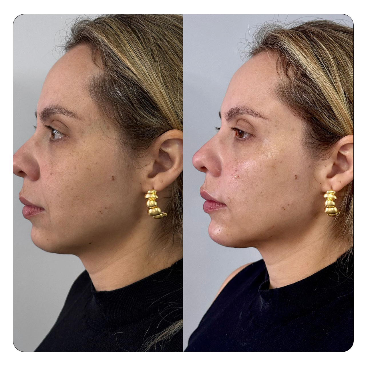 Natural Face - Resultado 1