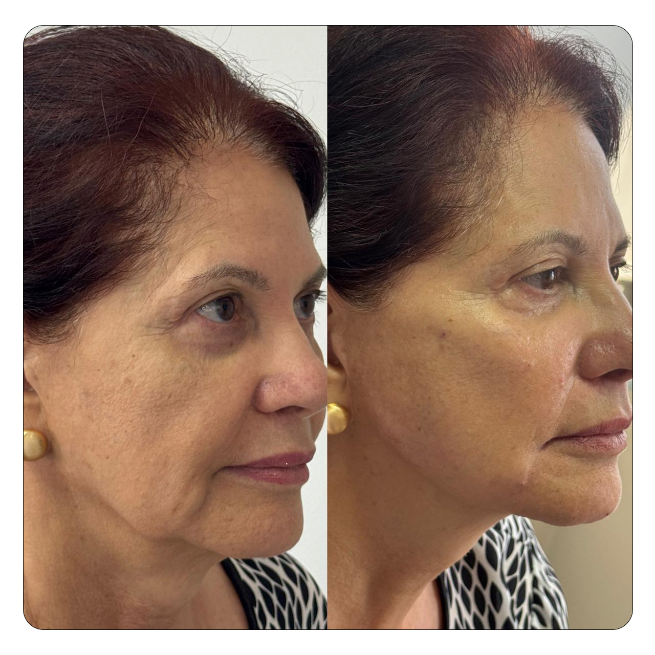 Natural Face - Resultado 2