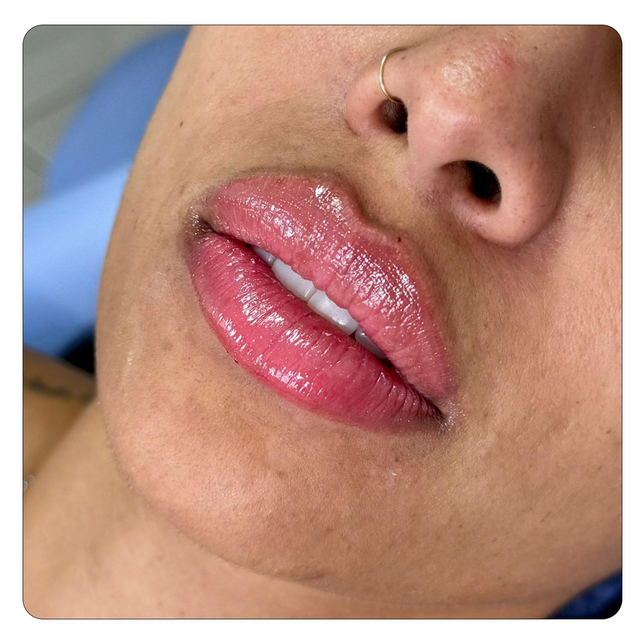 Preenchimento Labial - Resultado 3