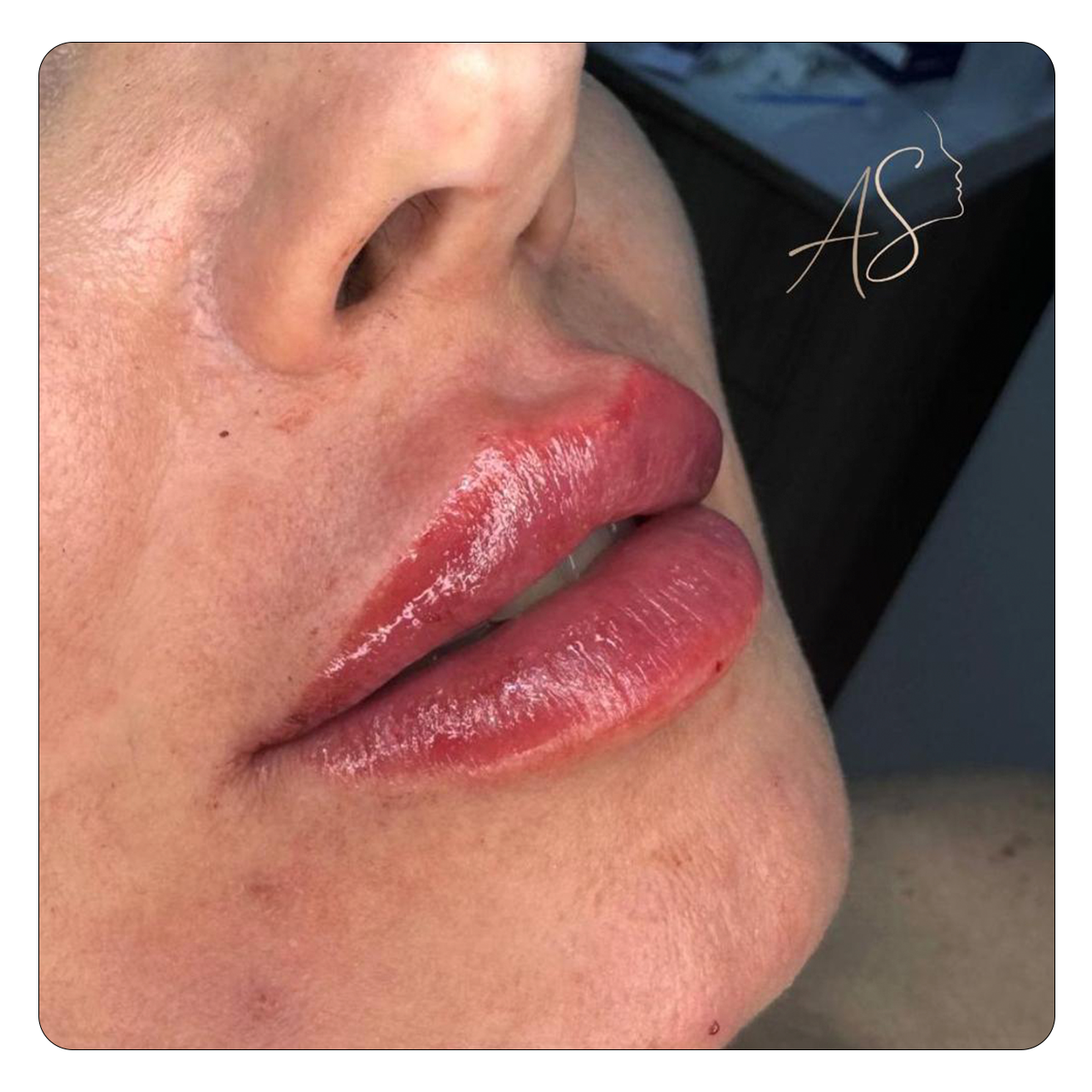 Preenchimento Labial - Resultado 4